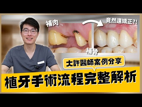 【植牙 #9】人工植牙手術流程完整解析！植牙全部治療流程需要多久？植牙的術後照顧與使用壽命？大許醫師植牙案例分享｜【祐民牙醫－隱適美旗艦店】許文斌醫師 #植牙  #假牙  #根管治療 #蛀牙