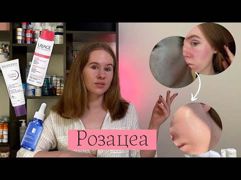 Уход за кожей при розацеа | Мой опыт | Аптечная косметика