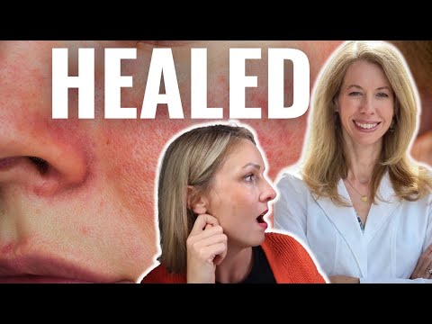 ROSACEA CAN BE HEALED: Skin Flushing, Blushing, & Erythrophobia with Dr. Tara O'Desky