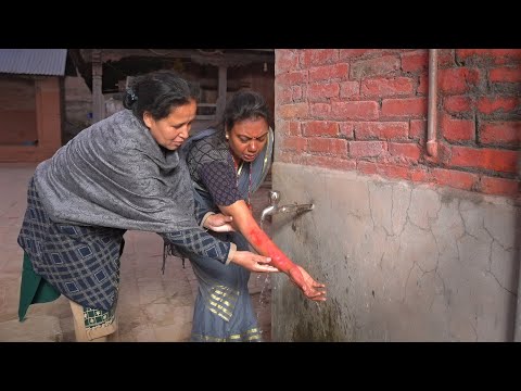 When to Go to the Hospital for a Burn - Emergency Care Series