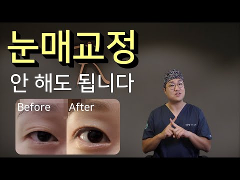눈매교정 안해도 되는 눈.  눈매교정 없이 눈이 커질 수 있음에도 눈매교정술을 권유받기 쉬운 눈의 형태와 누구나 쉽게 그 여부를 판단할 수 있는 기준을 알려드릴게요.