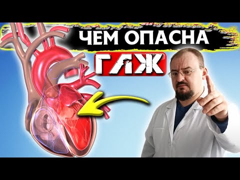 В чем ОПАСНОСТЬ ГИПЕРТРОФИИ левого желудочка сердца и как нужно лечить
