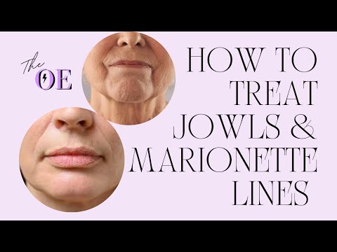 How To Treat Jowls & Marionette Lines At Home