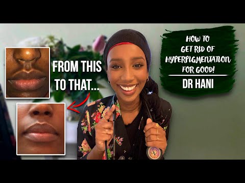 How To Get Rid Of Hyperpigmentation! | Dr Hani