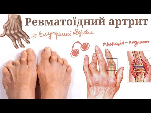Ревматоїдний артрит: етіопатогенез, класифікації, клініка, діагностика, лікування - лекція-подкаст
