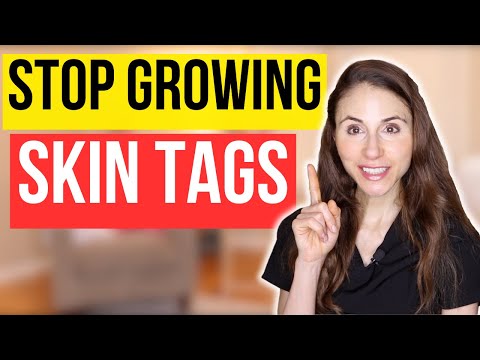 How To Stop Skin Tags From Growing | Dermatologist Tips