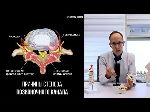 Стеноз позвоночного канала: причины, диагностика и поэтапный план лечения