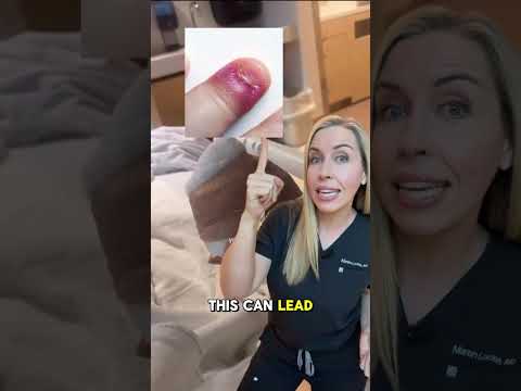 Biting your nails can lead to this….🥵 #nails #habits #dermatologist