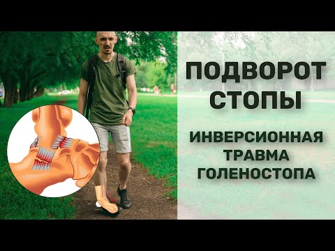 Подворот стопы. Что делать? Инверсионная травма голеностопа.