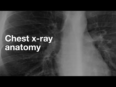 Basic chest x-ray anatomy