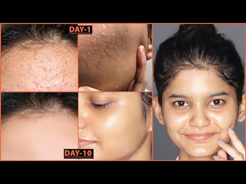 How to remove TINY BUMPS Naturally at HOME | Get Rid of TINY BUMPS/BUMPY SKIN Naturally |