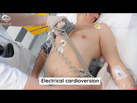 Electrical cardioversion