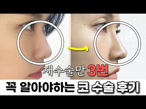 코수술 부작용으로 3번 재교정했습니다…💦 코수술 후기 싹 다 알려드릴게요!! (병원정보/통증&붓기/부작용/병원고르는법/가격)ㅣ로주RhoJu