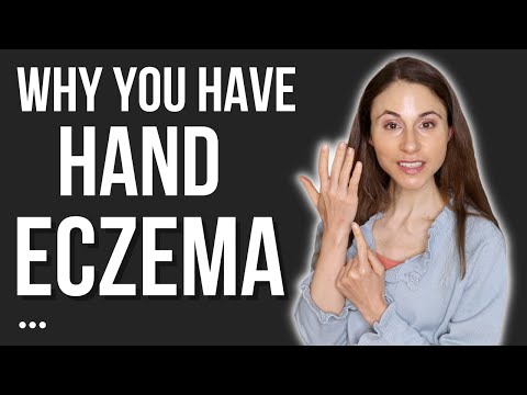 THIS IS WHY YOU HAVE HAND ECZEMA 🖐 DERMATOLOGIST @Dr Dray