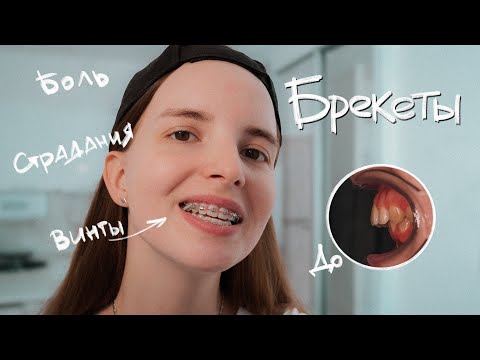 Всё, что нужно знать о БРЕКЕТАХ. Страдания, которые меняют жизнь к лучшему | Моя история.