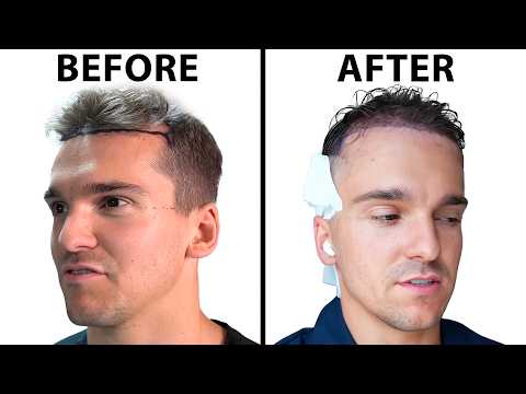 I got a hair transplant in Turkey | Hair Surgeon Reacts