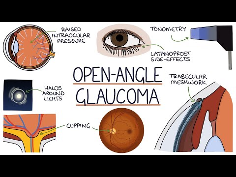 Understanding Open Angle Glaucoma