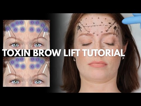 How to Inject 'the Botox Brow Lift' - Avoid Spock Brow & Brow Ptosis