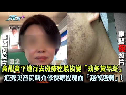 東張西望｜貪靚貪平進行去斑療程最後竟變「勁多黃黑斑」 追究美容院轉介修復療程塊面「越做越爛」!｜美容院｜去斑療程｜爛面｜李旻芳｜王汛文