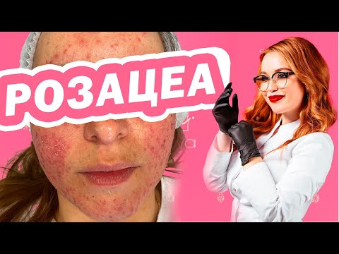 РОЗАЦЕА что это такое и как лечить? (КУПЕРОЗ, или РОЗОВЫЕ УГРИ)