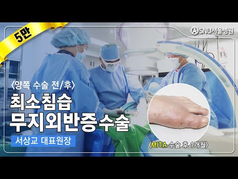 최소침습 무지외반증수술, 양쪽 수술 전, 후 이야기!! #무지외반증 #최소침습무지외반증수술 #무지외반증수술 #MICA #SNU서울병원 #서상교