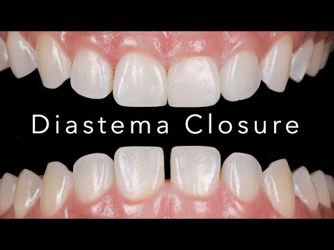Diastema Closure with composite filling: step by step