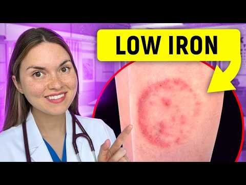 14 Signs of IRON DEFICIENCY You Can See: Doctor Explains