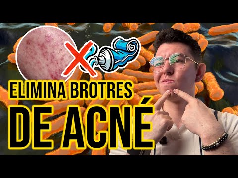 EVITA los BROTES de ACNÉ! | DrPoloGuerrero