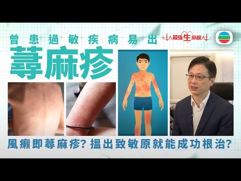 最強生命線|有過敏病史易出蕁麻疹 低組織胺飲食減輕過敏反應(繁 / 簡字幕)|醫療|治療|無綫新聞TVB News