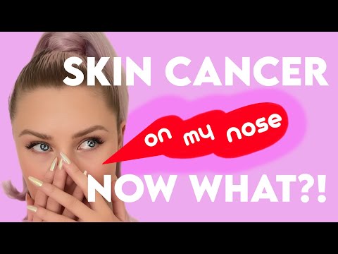 Mohs Surgery On My Nose! Pictures and Details of Skin Cancer Treatment on my Face