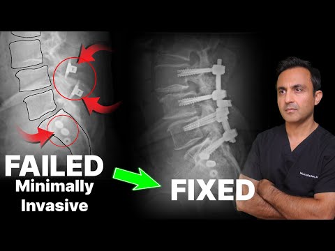 Failed minimally-invasive spine surgery: Why it failed and how I fixed it