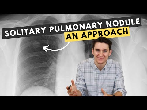 My approach to solitary pulmonary nodules