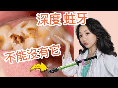 『補牙必看』出現這個狀況 要馬上跟牙醫說！補牙完 牙齒變敏感？@DrTeresa
