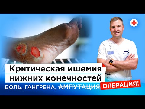 Критическая ишемия нижних конечностей: как избежать ампутации? | Бесплатная операция по ОМС