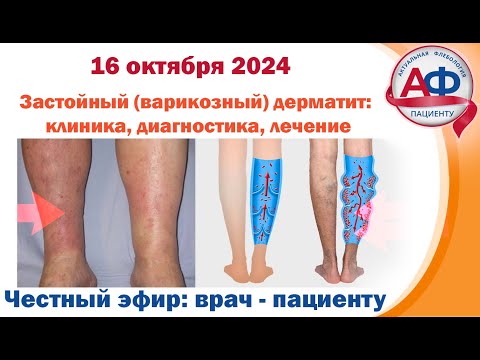 Застойный варикозный дерматит клиника, диагностика, лечение