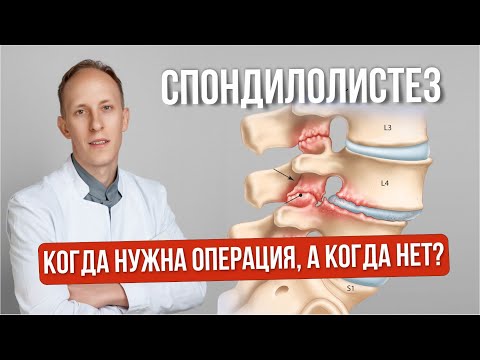 Спондилолистез. Обзор методов лечения