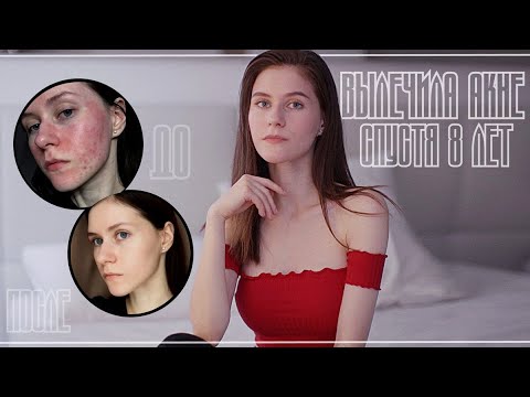 Как я вылечила АКНЕ спустя 8 лет за 1 месяц [подробно]