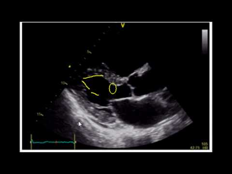 Estimating Ejection Fraction with Point of Care Echo