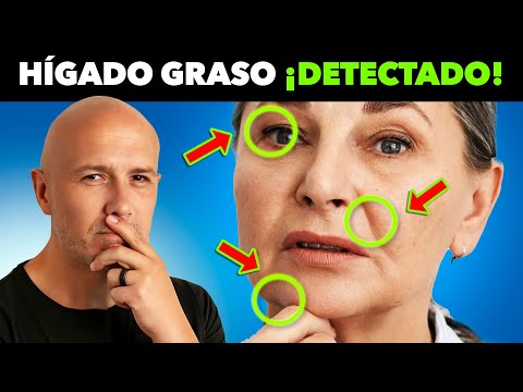 ¡TODAS Las Personas Que Tienen HÍGADO GRASO Tienen ESTO En Común! Signo OCULTO Que DEBES Conocer