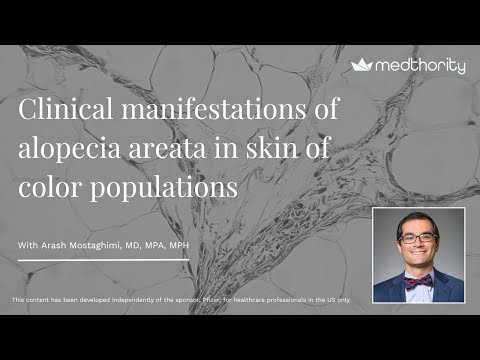 Clinical manifestations of alopecia areata in skin of color populations
