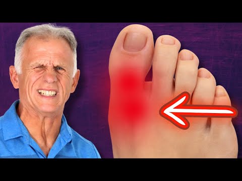 BIG Toe Pain!! RELIEF & Walk Normal Again (Hallux Rigidus)