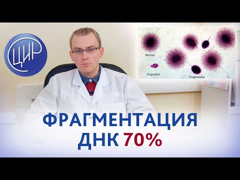 Бесплодие с высоким уровнем фрагментации ДНК сперматозоидов. Что делать? Андролог Живулько А.Р.