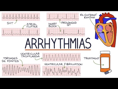 Understanding Arrhythmias