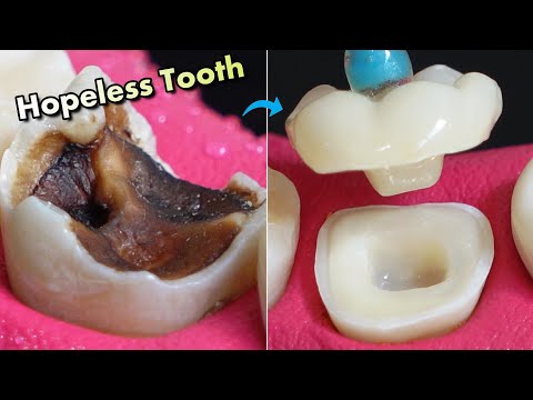 IMPOSSIBLE Restoration Of Tooth Caries ! Amazing Before And After.