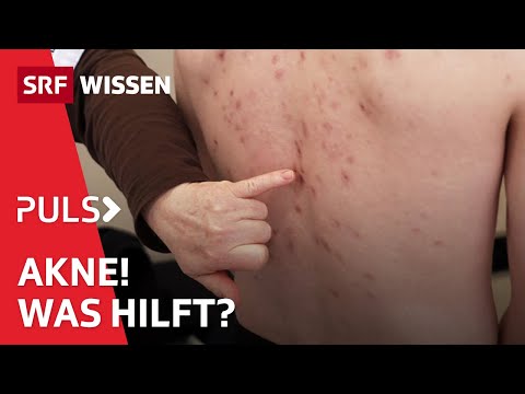 Pickelalarm – Wie werde ich Akne wieder los? Konkrete Tipps und Ratschläge | Puls | SRF Wissen