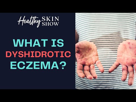 Dyshidrotic Eczema (HAND ECZEMA): How It Changed My Life Forever | Jennifer Fugo