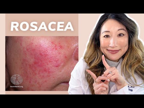 Dermatologist Guide to ROSACEA - Treatments & Skincare Products