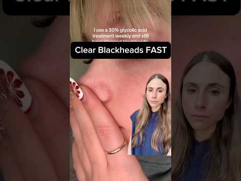 How to Clear Blackheads FAST #dermatologistadvice