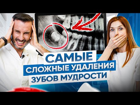 ТОП 3 самых сложных случаев удаления зубов мудрости