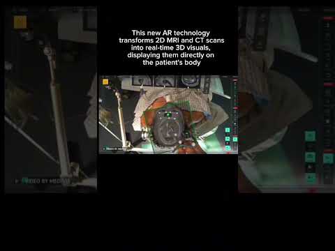 AR technology transforms 2D MRI and CT scans into real-time 3D displaying directly on body #ai